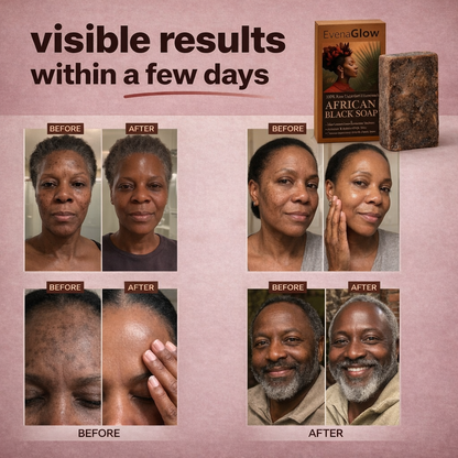 Anti-Dark Spots & Acne African Black Soap